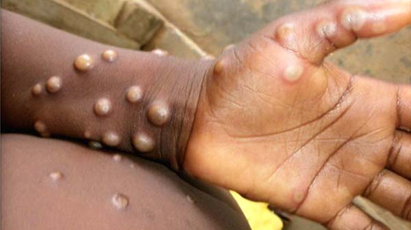 Monkeypox Monkeypox